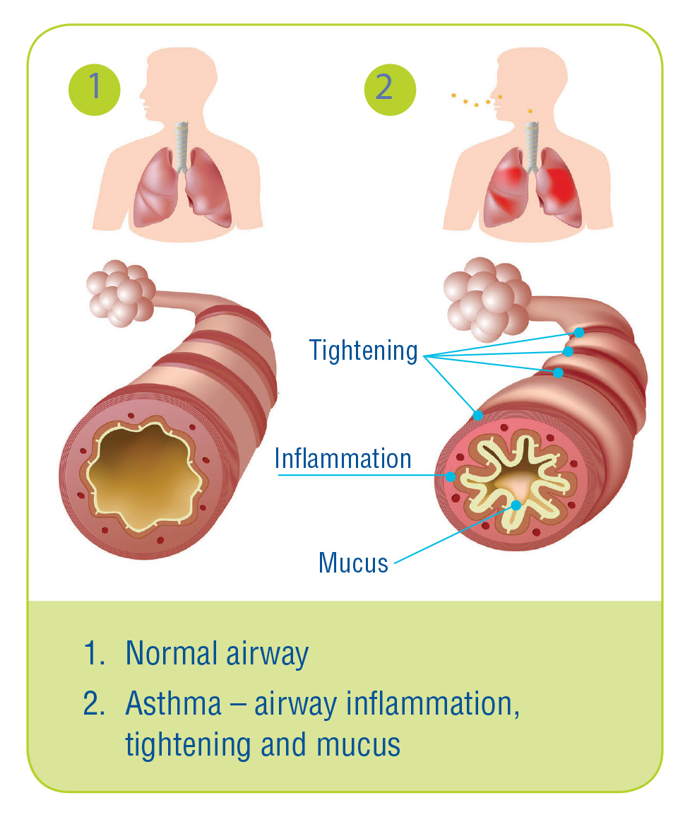 Asthma airways
