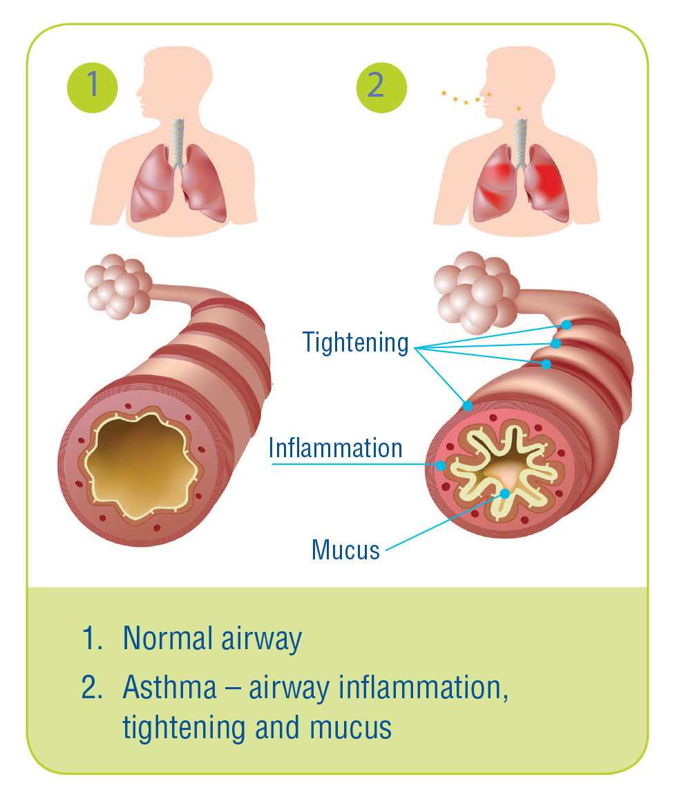 Asthma The Lung Association