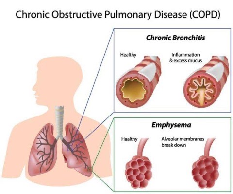 Chronic Obstructive Pulmonary Disease (COPD)