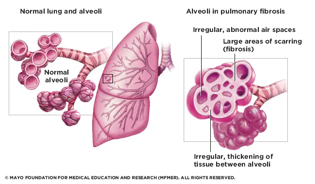 Pulmonary Fibrosis