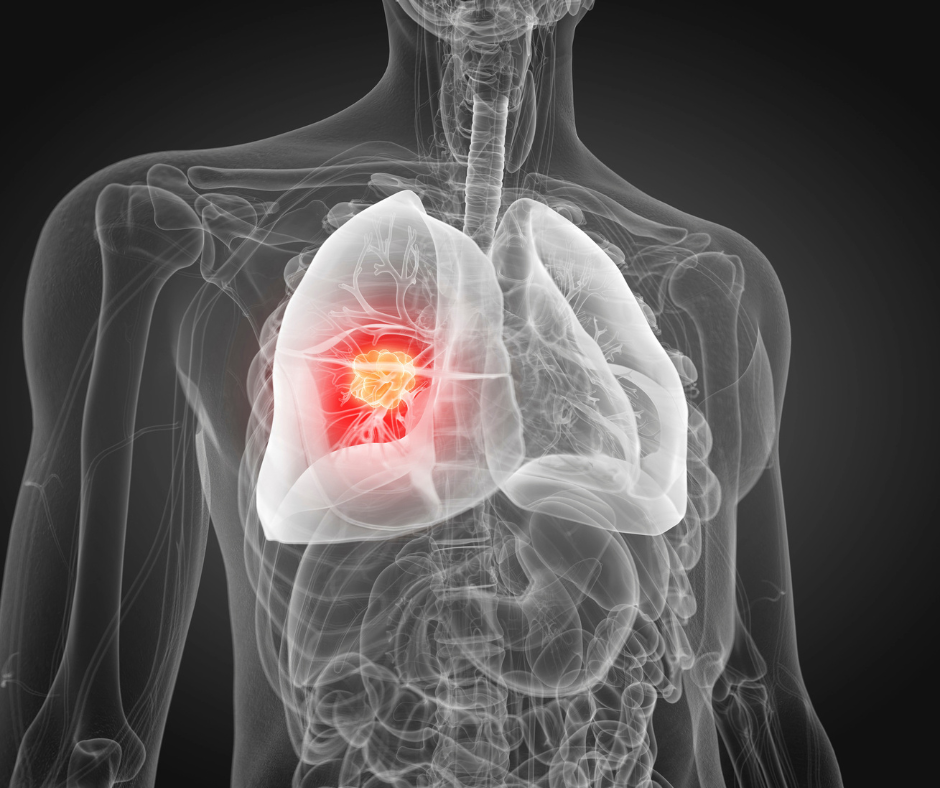 lung-cancer